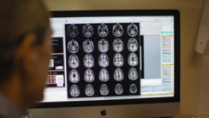 Az Alzheimer-kór négy altípusát azonosították