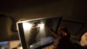 WHO: ismét terjed Európában a TBC