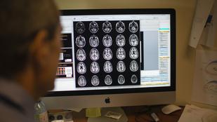 Az Alzheimer-kór négy altípusát azonosították