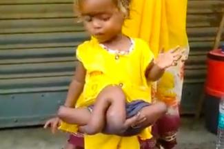 Póklány: két-két plusz karral és lábbal jött világra egy indiai kislány